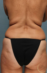 Coolsculpting Case 3 Before